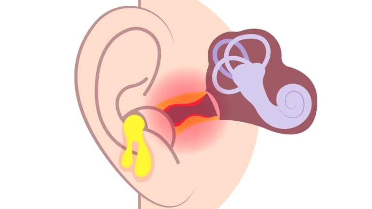 Bí quyết trị viêm tai giữa ở người lớn hiệu quả và an toàn