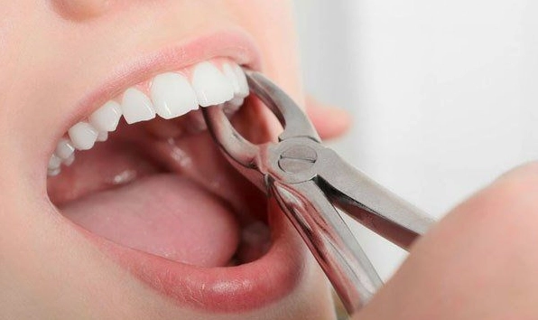 Các Cách Cầm Máu Sau Khi Nhổ Răng Hiệu Quả